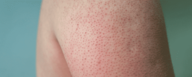 Cómo usar el ácido glicólico: (Guía para principiantes en 2026) 3 acido glicolico queratosis pilaris